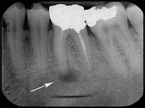 X-ray image of previously root canal treated tooth